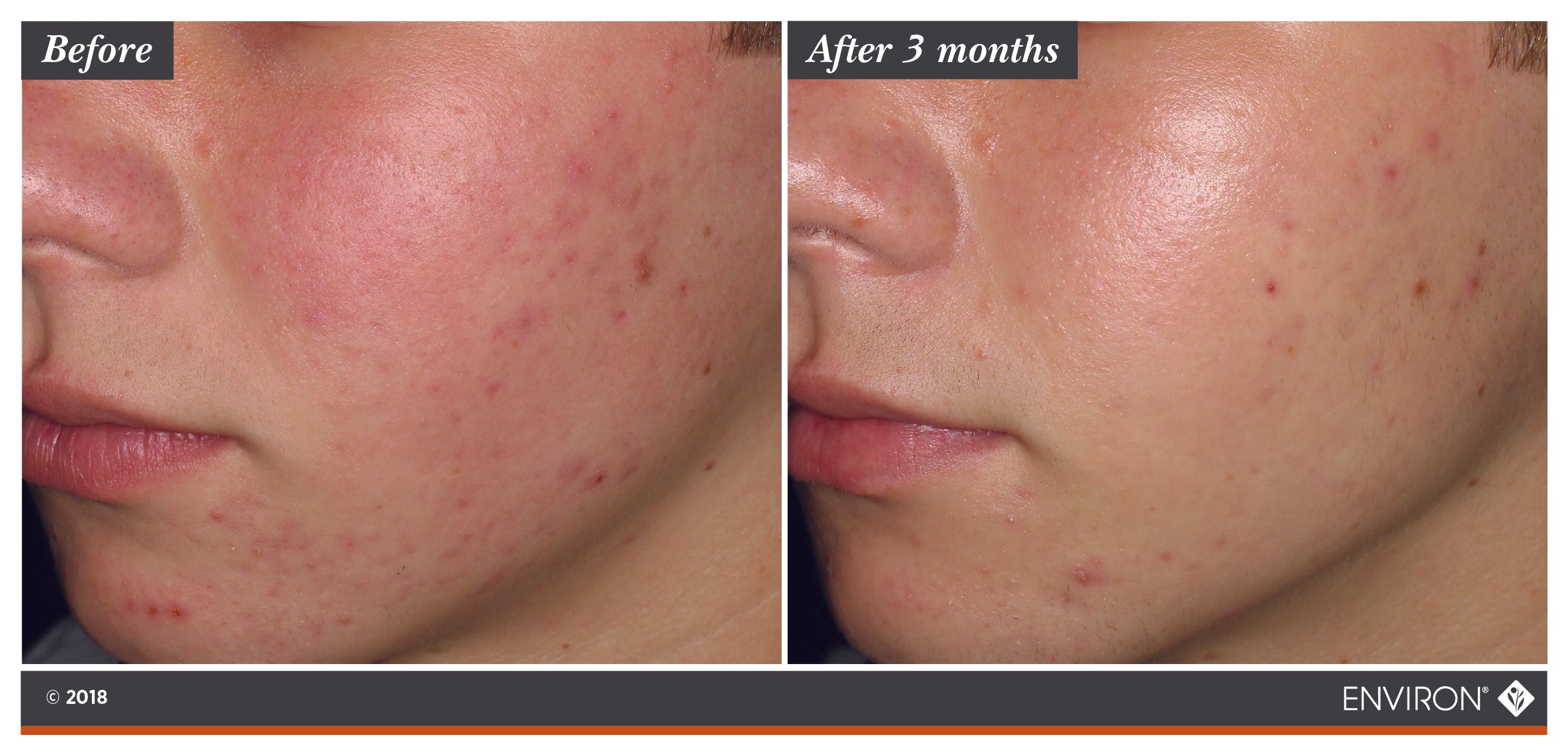 Botanical Infused Sebu-Tone Clarifier