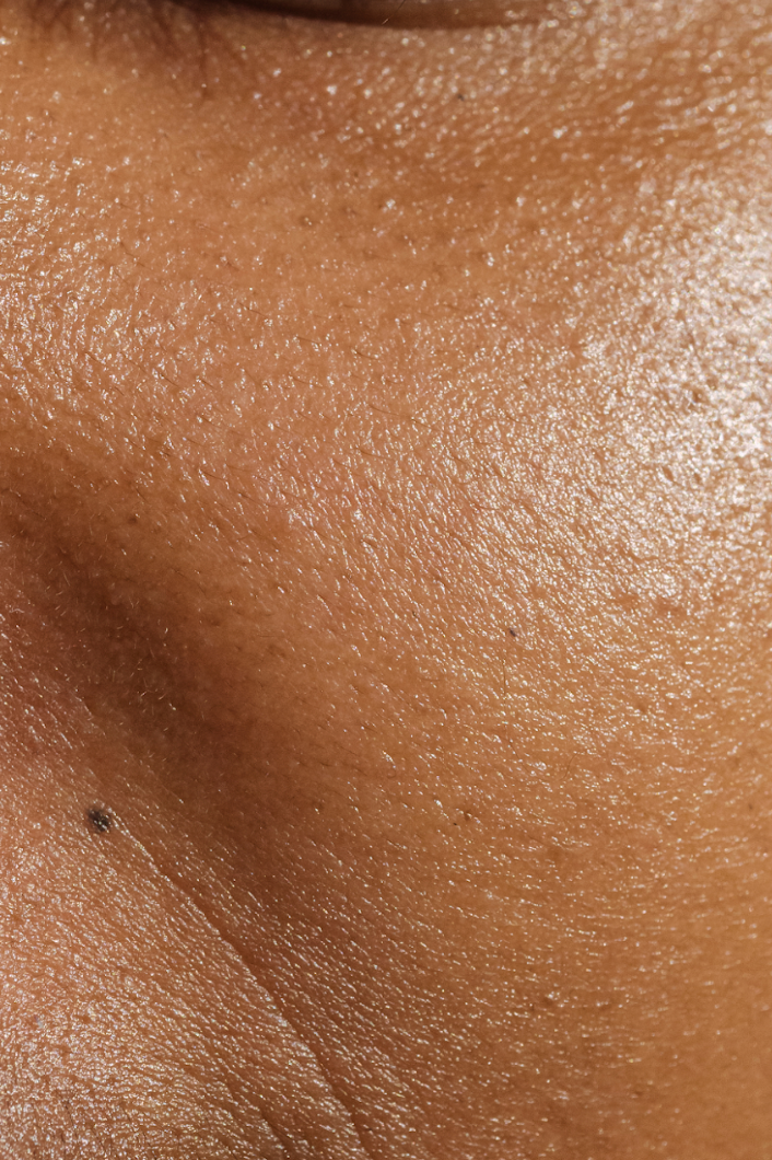What is Uneven Skin Tone and What Causes It