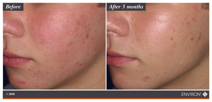 Botanical Infused Sebu-Tone Clarifier