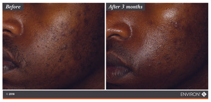 Botanical Infused Sebu-Tone Clarifier